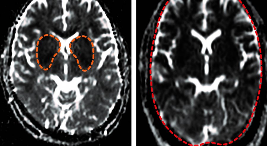 Scientists solve 100-year-old cerebral malaria mystery using neuroimaging techniques